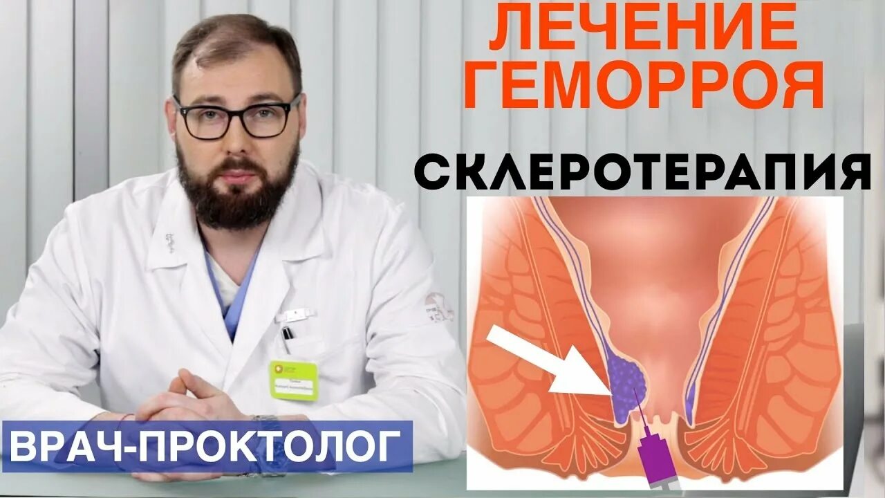 Эффективное лечение геморроя отзывы. Склеротерапия геморроя. Склеротерапия внутренних геморроидальных узлов.