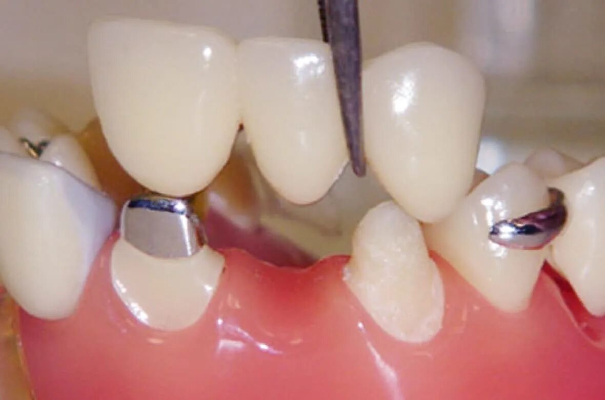 Почему ставят коронки. Мостовидный протез на 1 зуб. Мостовидный протез на 3 зуба. Мостовидный протез фронтальные зубы. Мостовидный протез на 2 зуба.