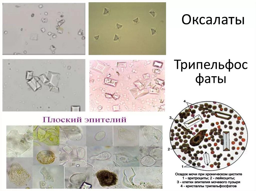 Фосфаты в какой моче. Микроскопия осадка мочи трипельфосфаты. Оксалаты трипельфосфаты. Кристаллы оксалата кальция в моче. Оксалаты кальция микроскопия.