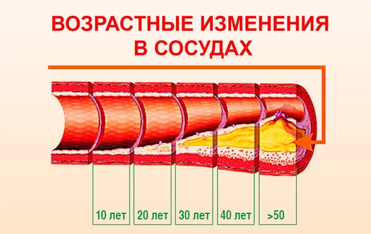 Возрастные изменения в сосудистой стенке. Возрастные изменения артерий и вен. Кровеносные сосуды старение. Возрастные изменения в стенке кровеносных сосудов.