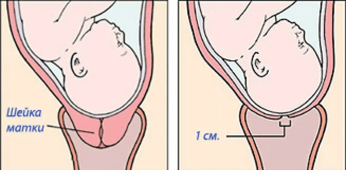 Как выглядит раскрытие перед родами. Схема раскрытия шейки матки. Раскрытие шейки на 1 палец. Роды раскрытие шейки матки 10см. Шейка матки 1 см при беременности.