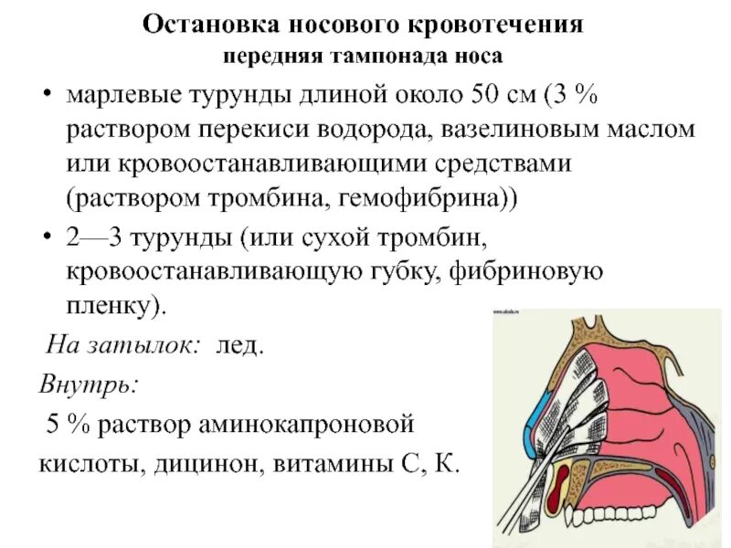 Носовые кровотечения клинические рекомендации. Остановка носового кровотечения. Остановка носового кровотечения передняя тампонада. Остановка родового кровотечения. Остановка носовго кровотечени.