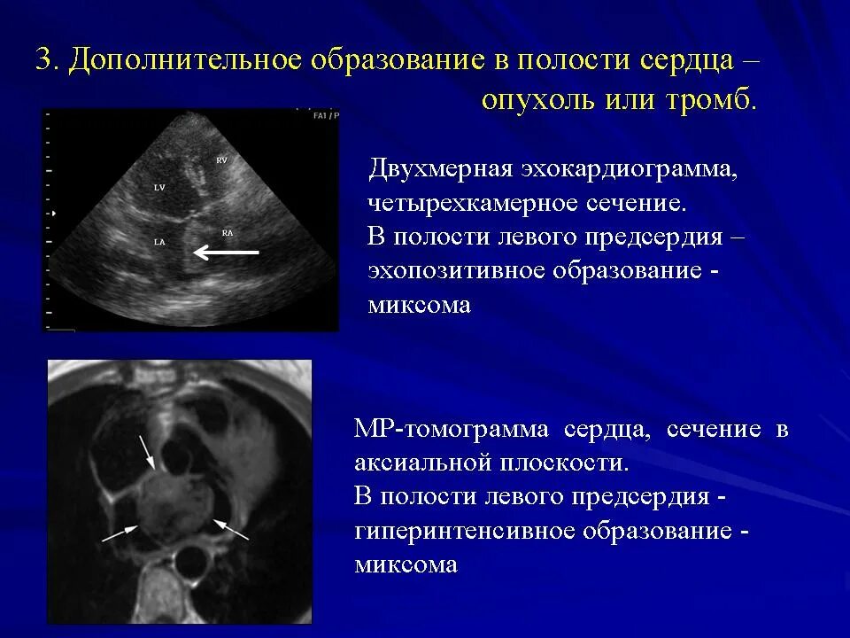 Образование левого предсердия