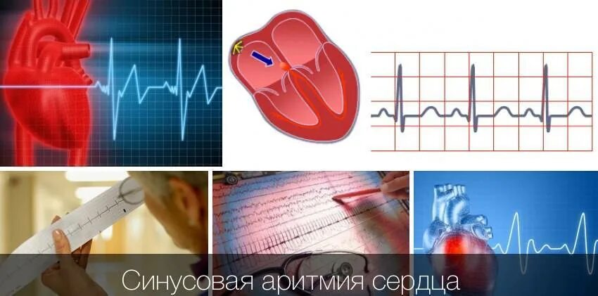 Аритмия сердца прибор. Аритмия сердца. сердцесинусовидная аритмия. нарушение сердечного ритма. сердечная аритмия.