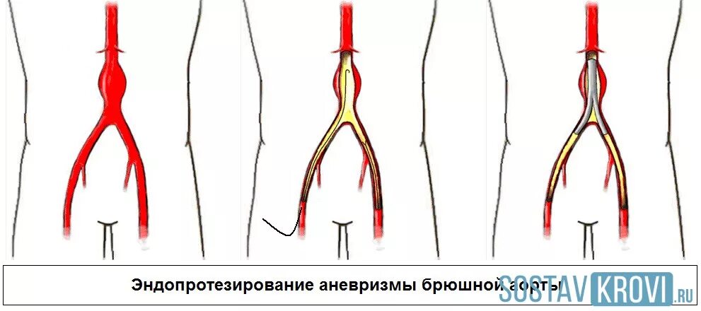 Аорта брюшной полости операция. Аневризма аорты операция. Эндоваскулярное протезирование аневризмы брюшной аорты. Операция аневризм аорты. Аневризма брюшной артерии.