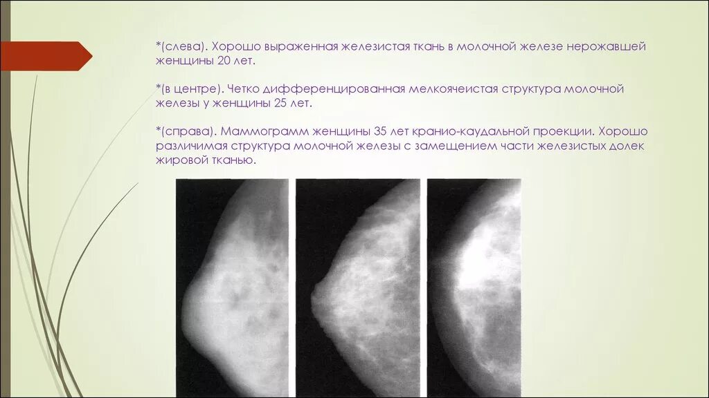 Мастопатия молочной железы маммограмма. Кистозно фиброзная мастопатия на маммографии. Структура молочных желез фиброзно-железистая ткань. Фиброзная мастопатия молочной железы на УЗИ.