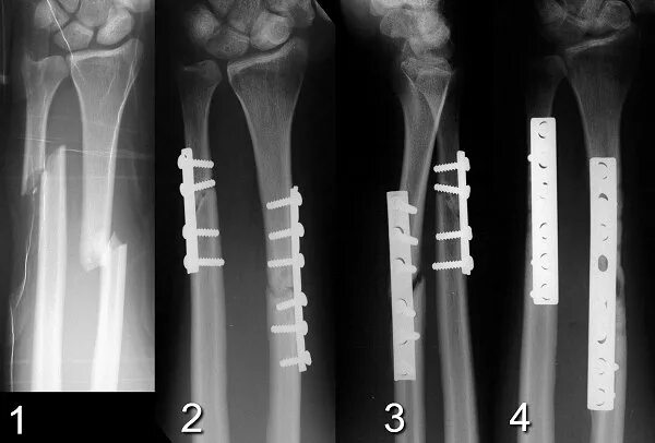 Трещина кости лечение. Остеосинтез костей предплечья рентген. Перелом 2х костей предплечья. Остеосинтез перелома лучевой кости. Перелом диафиза лучевой кости рентген.