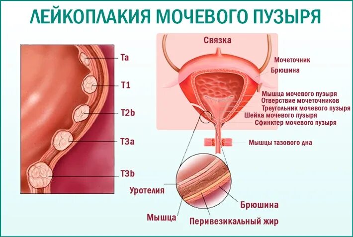 Болезнь мочевого пузыря у женщин лечение. Цистоскопия лейкоплакия. Лейкоплакия мочевого пузыря. Лейкоплакия мочевого пузыря симптомы. Лейкоплакия шейки мочевого пузыря.