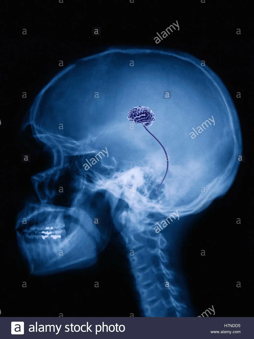 И голова без мозгов. Маленький мозг. Крошечный мозг. Маленький мозг в голове. Рентген головы с маленьким мозгом.