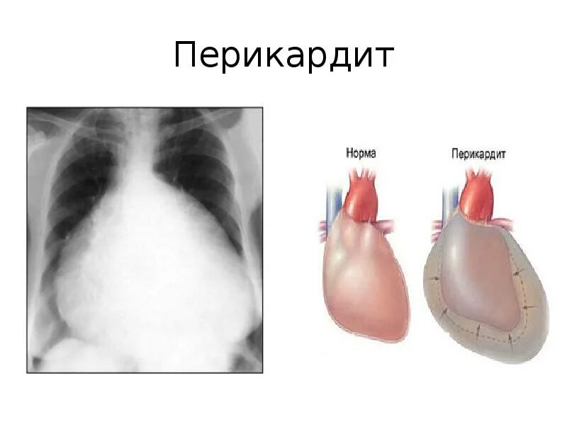 Перикард у детей. Экссудативный перикардит эхокардиография. Гидроперикард тампонада сердца. Перикард у детей. Травматический перикардит.