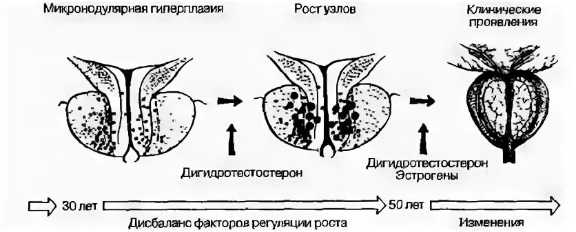Патогенез гиперплазии предстательной железы. Этиология патогенез доброкачественной гиперплазии простаты. Схема патогенеза аденомы простаты. Аденома (гиперплазия) предстательной железы патогенез. Предстательная железа включения