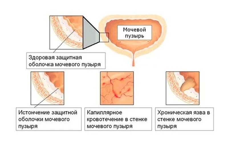 Заболевание цистит болезнь. Цистит после слинговой операции. Острый цистит осложнения.