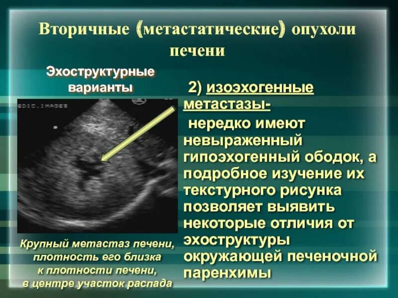Повышенной эхогенности неоднородной структуры