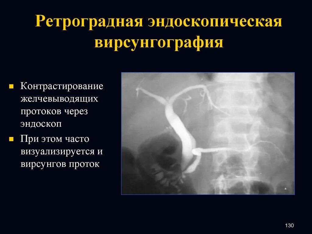 Нормальный пищевод. Контрастирование желчных протоков. Ретроградное контрастирование это. Ретроградная вирсунорография. Хронический панкреатит вирсунгография.