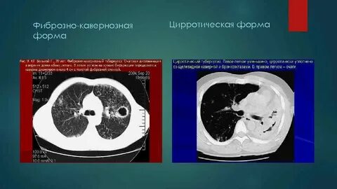 Кавернозный туберкулез кт
