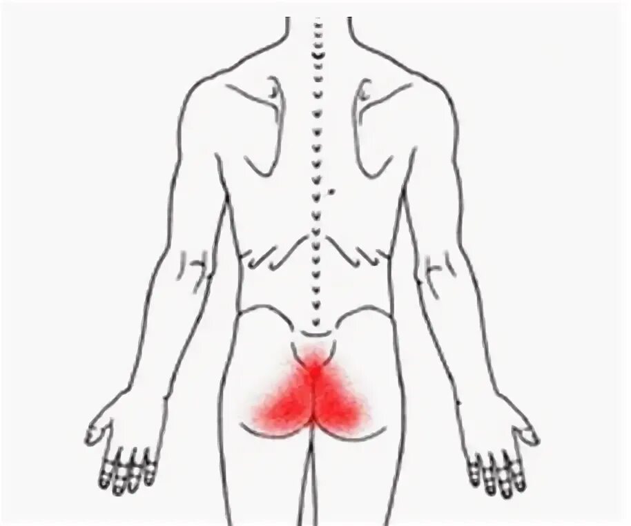 Болит спина отдает в ягодицу. Болевой синдром в крестце. Больные точки на крестце. Болит поясница и крестец.