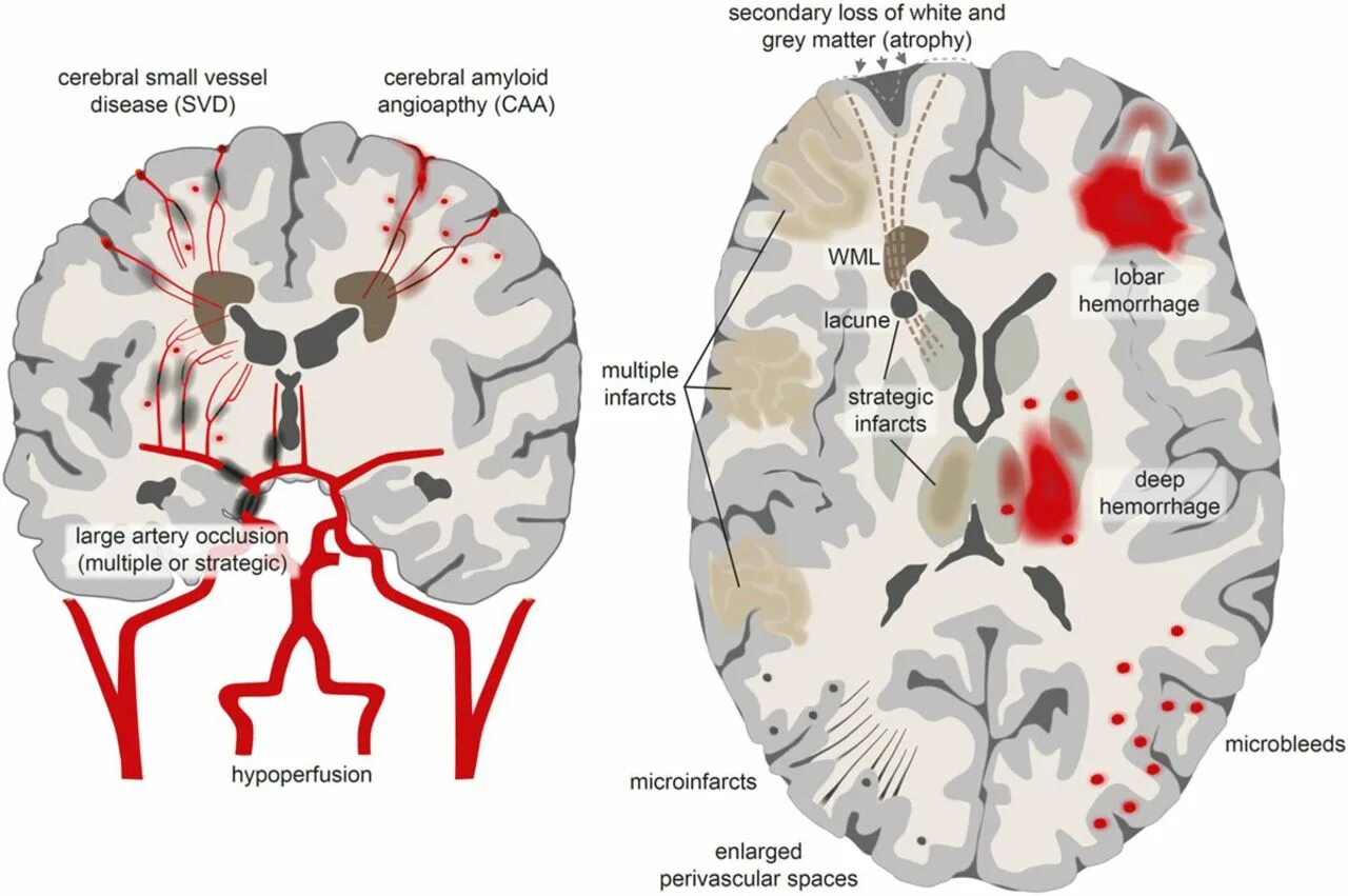 The brain consists of grey and white