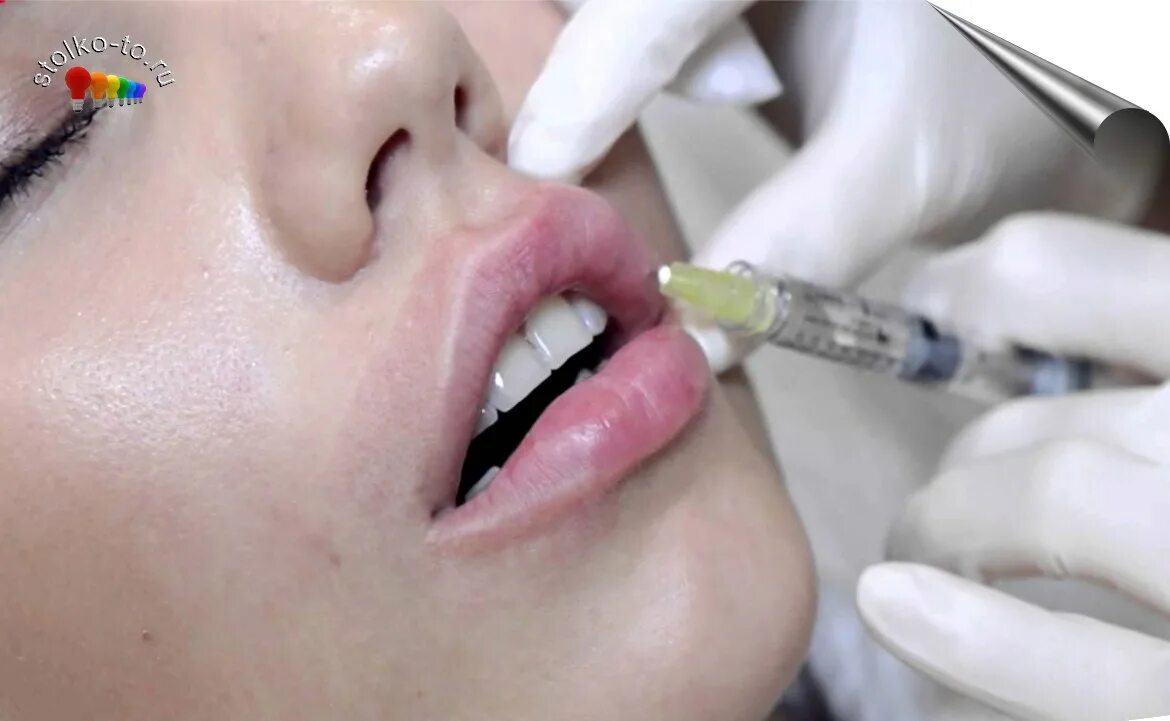 5 мл. Накачивание губ гиалуроновой кислотой 0. Губы накаченные гиалуроновой кислотой 1 мл. Губы гиалуроновой кислотой до и после до и после 1 мл. Пластика колонны фильтрума.