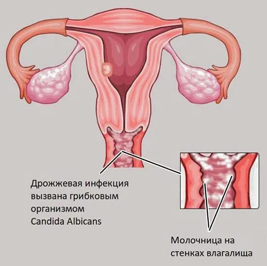 Почему во время месячных причины. Невыносимые боли при менструации. боли во влагалище при менструации. сильные боли при менструации. болит влагалище во время месячных.