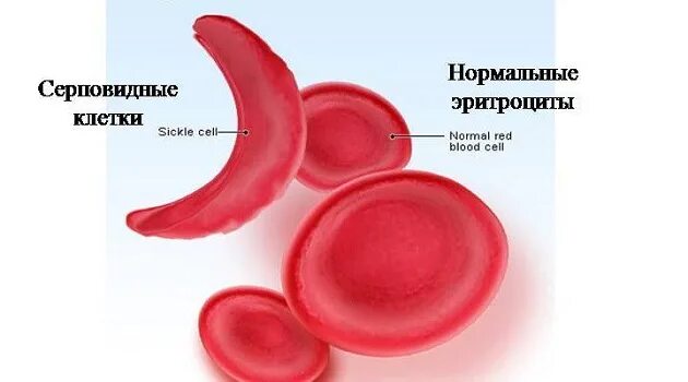Нормальная форма эритроцитов неполно доминирует над серповидной