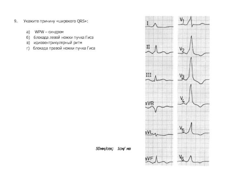 Блокада qrs. ЭКГ критерии блокады левой ножки пучка Гиса. Блокада правой ножки пучка Гиса на ЭКГ. ЭКГ блокада ножек пучка Гиса заключение. АВ блокада левой ножки пучка Гиса на ЭКГ.