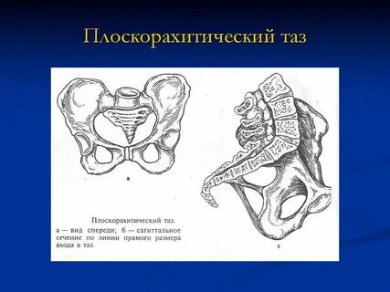 Плоский таз размеры