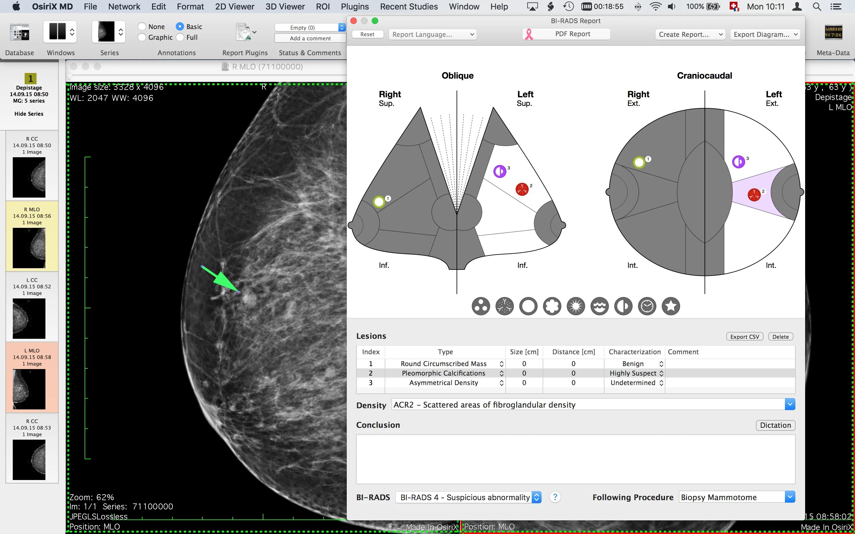 Тип молочных желез acr 2. Osirix dicom. acr классификация маммография. dicom формат. acr d маммография.