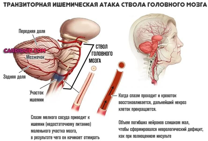 Поражение ствола головного. Гипертензивная энцефалопатия патогенез. Микро инсульт головного мозга.