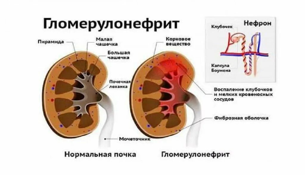 Осложнения острого гломерулонефрита патогенез. Острый диффузный гломерулонефрит осложнения. Острый гломерулонефрит этиология. Гломерулонефрит патогенез почки. Хронический диффузный гломерулонефрит