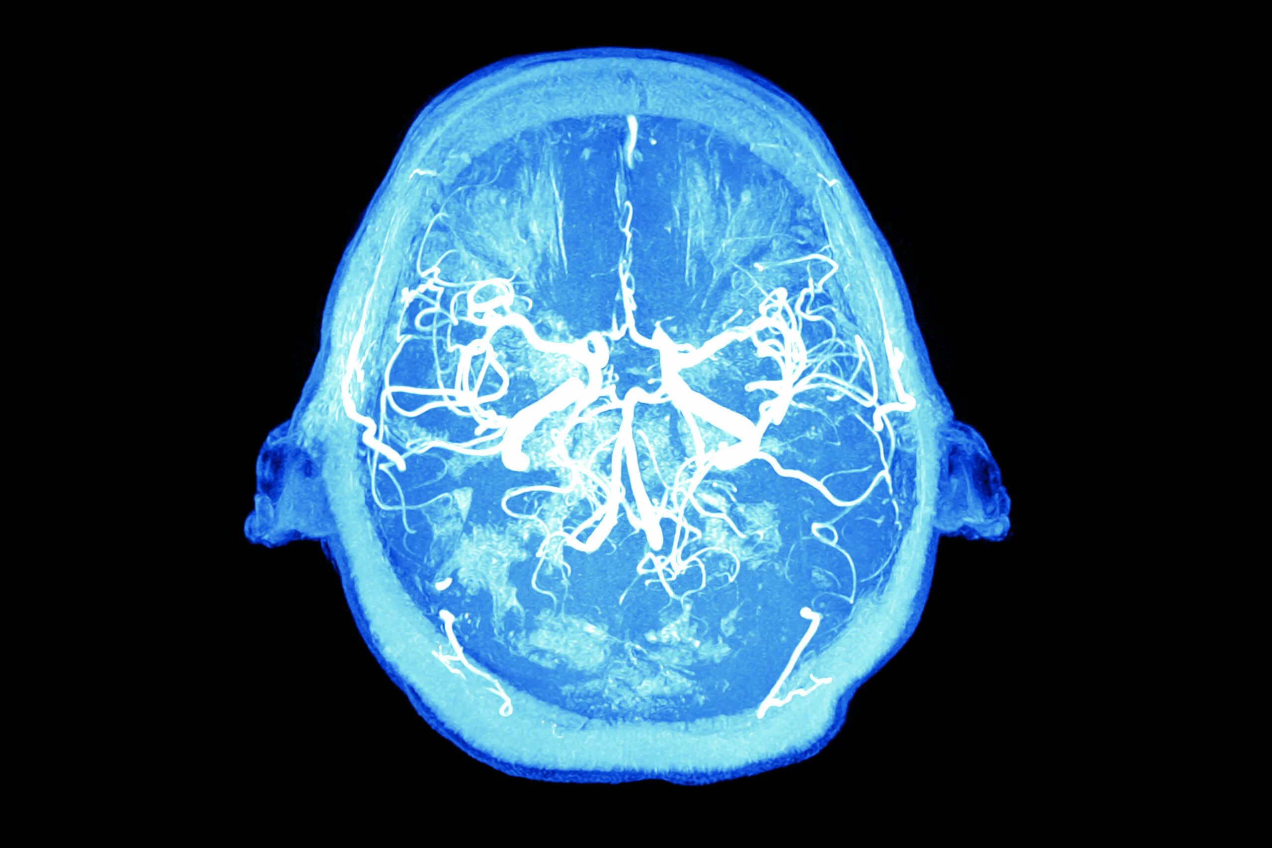 Brain 81. Кавернозная кавернома. Кавернозная ангиома мрт. Кавернозная гемангиома головного мозга.