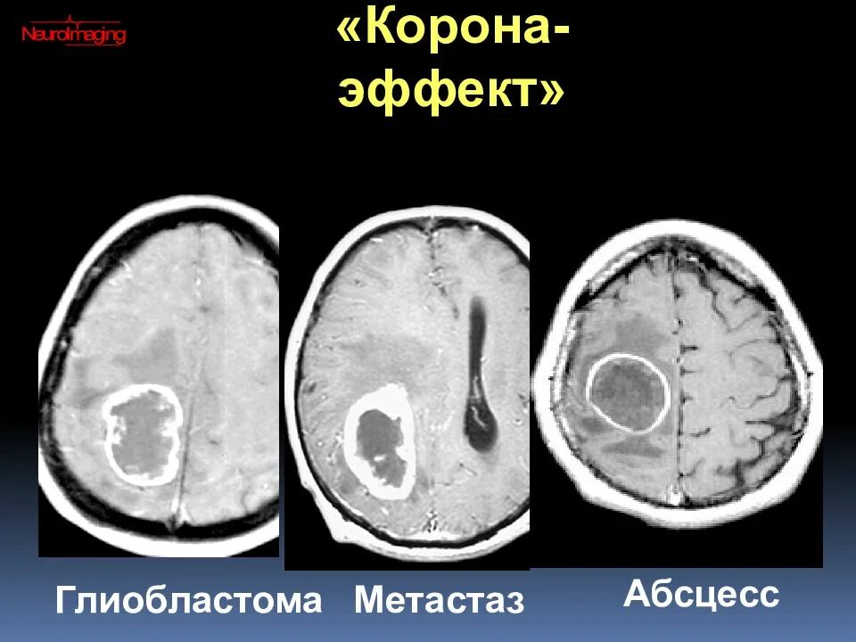 Метастазы головного мозга кт. Глиобластома кт картина. глиобластома головного мозга на кт. кт при абсцессе головного мозга. глиобластома на кт на кт.