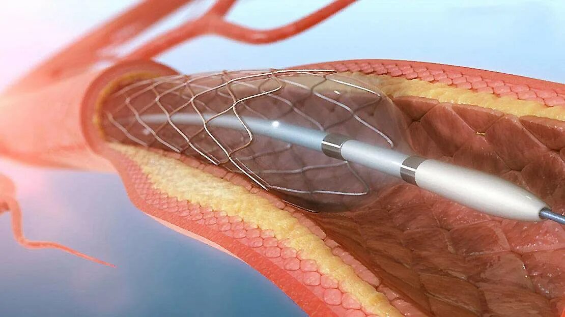 Стент после операции. Баллонная коронарная ангиопластика. Чрескожная ТРАНСЛЮМИНАЛЬНАЯ баллонная коронарная ангиопластика.. Коронароангиография стентирование. Эндоваскулярная стентирование.