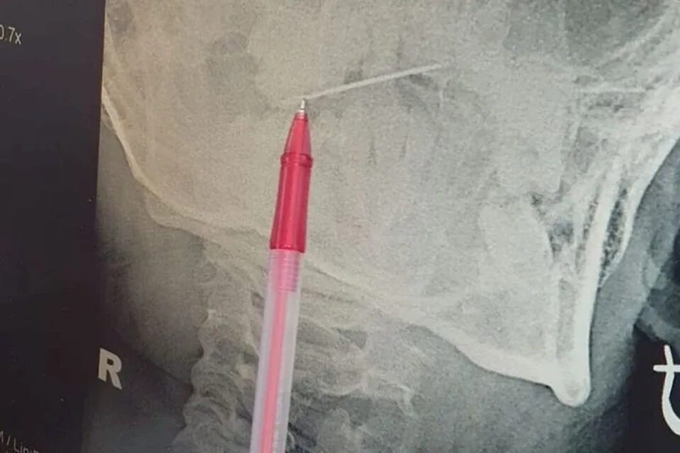 Оверлок швейная машина 4 ниточный иглы. Janome tc2212. Нитковдеватель для швейной машины ягуар. Палец прошит иголкой машинки швейной. Инородный предмет в носу.