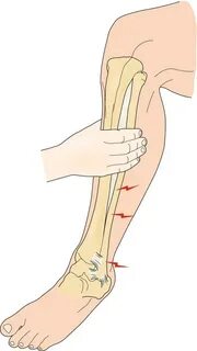 Sprained leg