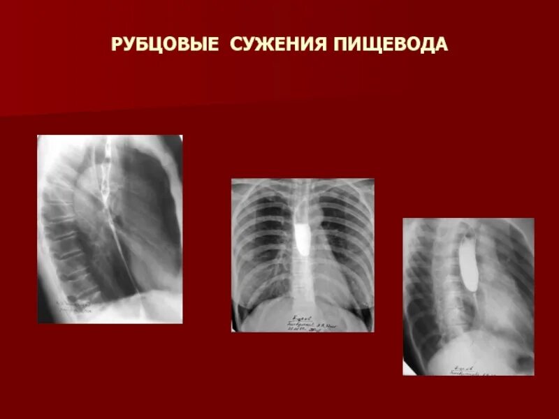 Рубцовые сужения пищевода. Декомпенсированный стеноз пищевода. Рубцовые сужения пищевода рентгенограмма. Стеноз пищевода бужирование. Рубчовый сужения пищавода.