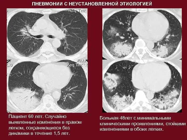 Можно ли кт. Бактериальная пневмония на кт легких. Эозинофильная пневмония кт. Бактериальная пневмония на кт. Крупозная пневмония на кт.