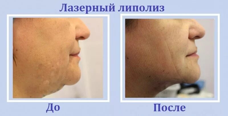Лазерный липолиз подбородка до и после отзывы Липосакция Подбородка 68 фото