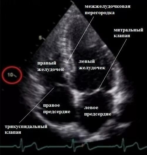 УЗИ сердца норма снимок. Эхокардиография норма и патология. Эхокардиография левое предсердие норма. ЭХОКГ норма снимок. Норма правого предсердия