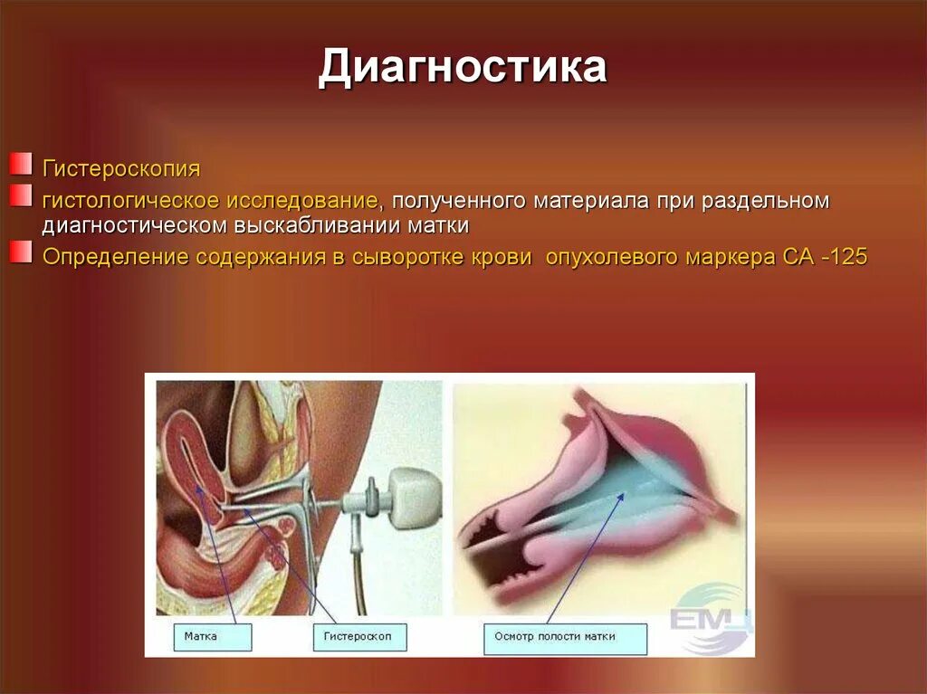 Раздельное диагностическое выскабливание. Гистероскопия с раздельным выскабливанием. Раздельное выскабливание матки. Раздельное диагностическое выскабливание полости матки.