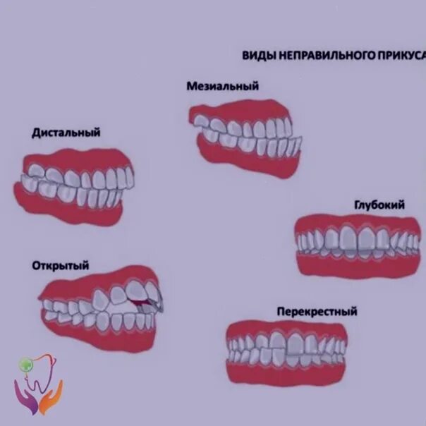 Прикус зубов: правильный и неправильный (много фото) - artshots.ru