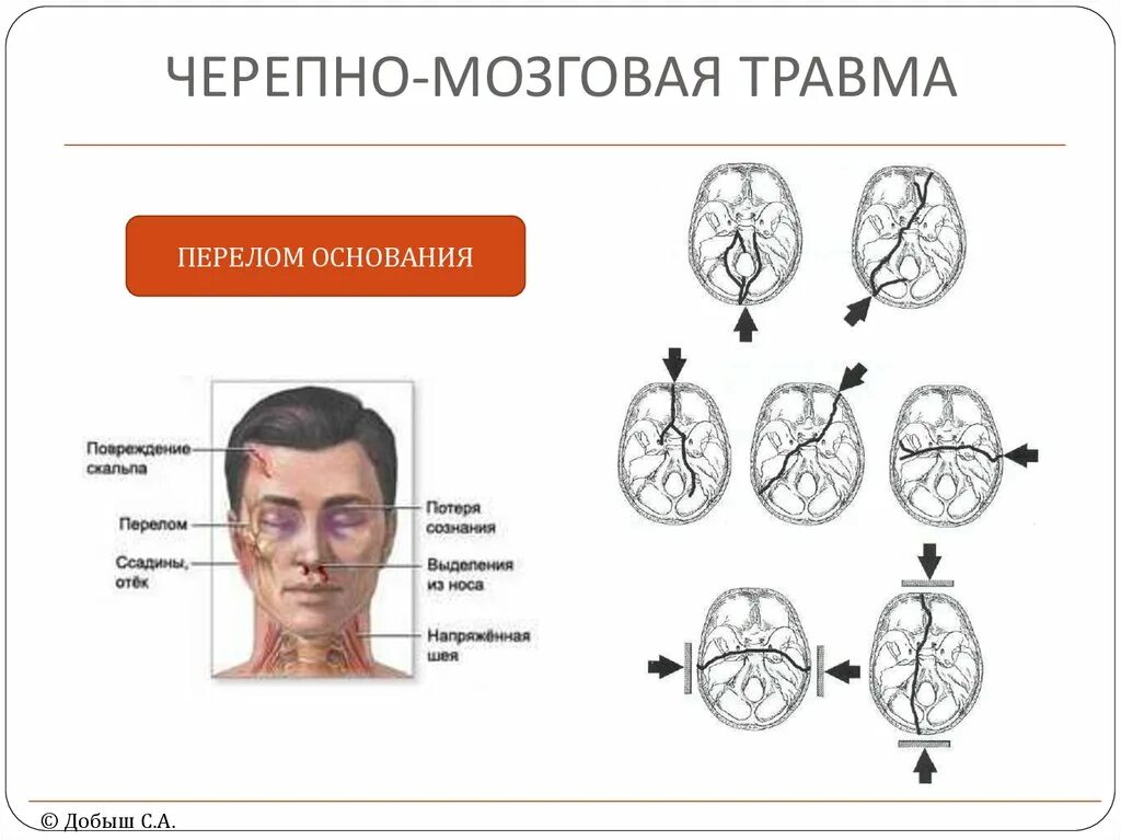 Травмы головного мозга схема. Сеоепно мозгоапя Травиа. Черепномозговя травма. Черпная Мозгово травма.