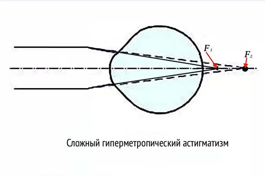 Сложный гиперметропический астигматизм глаз. Сложный гиперметропический астигматизм. Сложный обратный гиперметропический астигматизм. Сложный гиперметропический астигматизм 2 степени. Сложный гиперметропический астигматизм 1 степени.