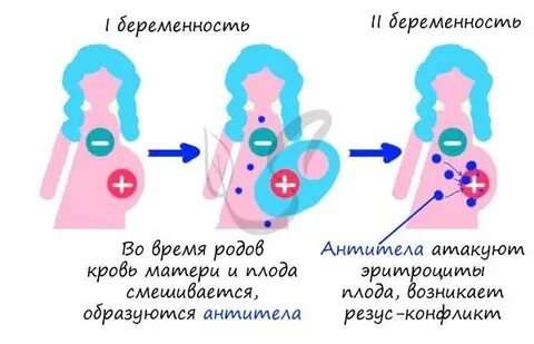 Антирезусные антитела при беременности