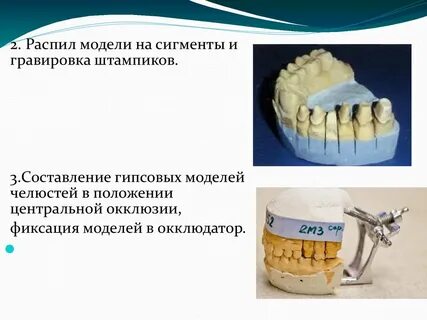 Металлокерамическая коронка этапы