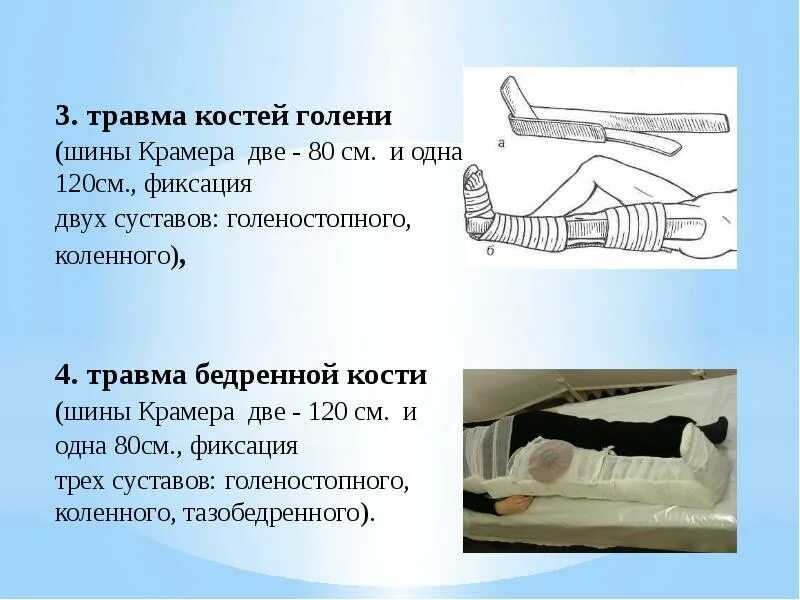 Какие суставы фиксируют при переломе бедра. Транспортная иммобилизация при переломе бедренной кости. иммобилизация при переломе костей голени. шины транспортные для иммобилизации нижних конечностей. протяженность иммобилизации при переломе бедра.