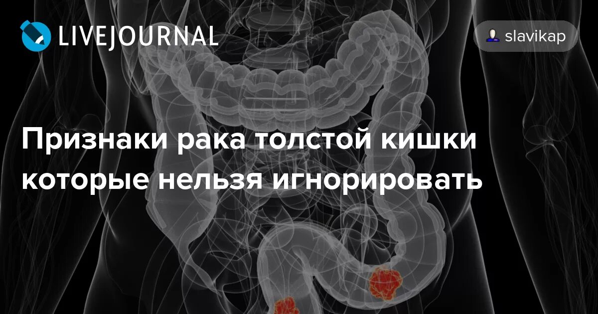 Опухоль толстой кишки симптомы. Симптоматика онкологии толстой кишки. Опухоль прямой кишки симптомы. Опухоль Толстого кишечника симптомы.