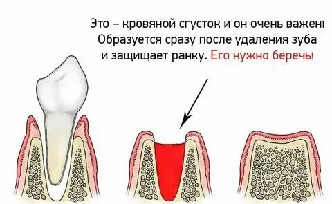 Вата после удаления зуба