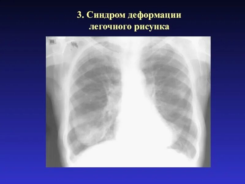 Легочный рисунок деформирован по петлистому типу. Синдром деформации легочного рисунка. легочный рисунок деформирован. синдром изменения легочного рисунка. деформация легочного рисунка на рентгене.