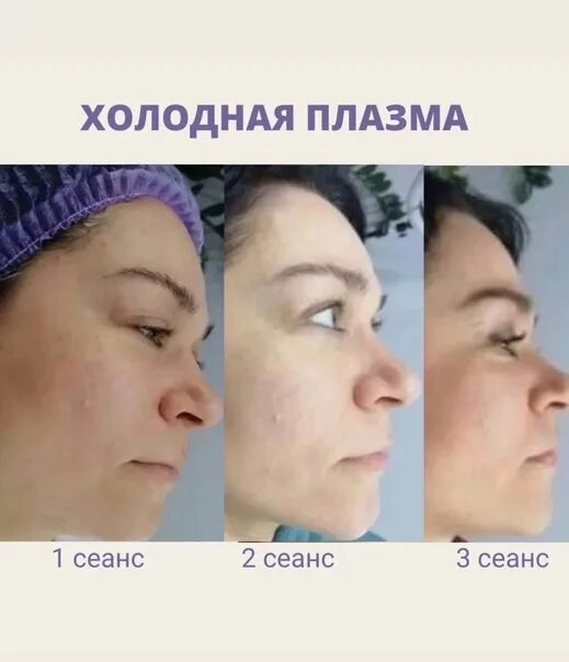 Холодное плазменное омоложение. Холодная плазма для лица в новосибирске. Холодная плазма для лица в самаре. Второй день после процедуры плазма лайнер фото. Процедура холодная плазма.