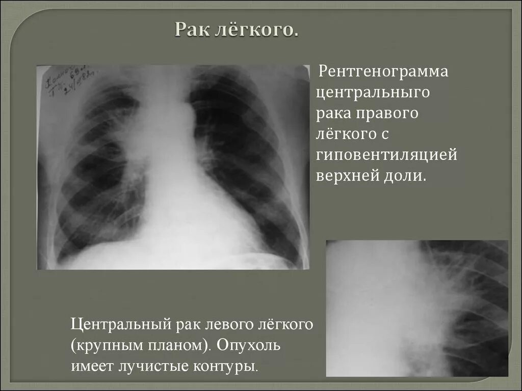 Заболевания левого легкого. Опухоль бронха рентген. Раковая опухоль на рентгене легких. Туберкулез бронхов рентгенограмма. Рентгенография легких при опухоли.